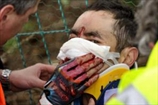 Казахский велосипедист перенес пластику носа после ужасного падения