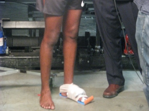 ФОТО: травма Джона Джонса Представляем вашему вниманию эксклюзивное фото травмированной ноги чемпиона UFC в полутяжелой весовой категории Джона Джонс. 