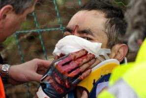 Казахский велосипедист перенес пластику носа после ужасного падения Гонщик Астаны Ассан Баззаев чуть не остался без носа на гонке "Три дня Панна". 